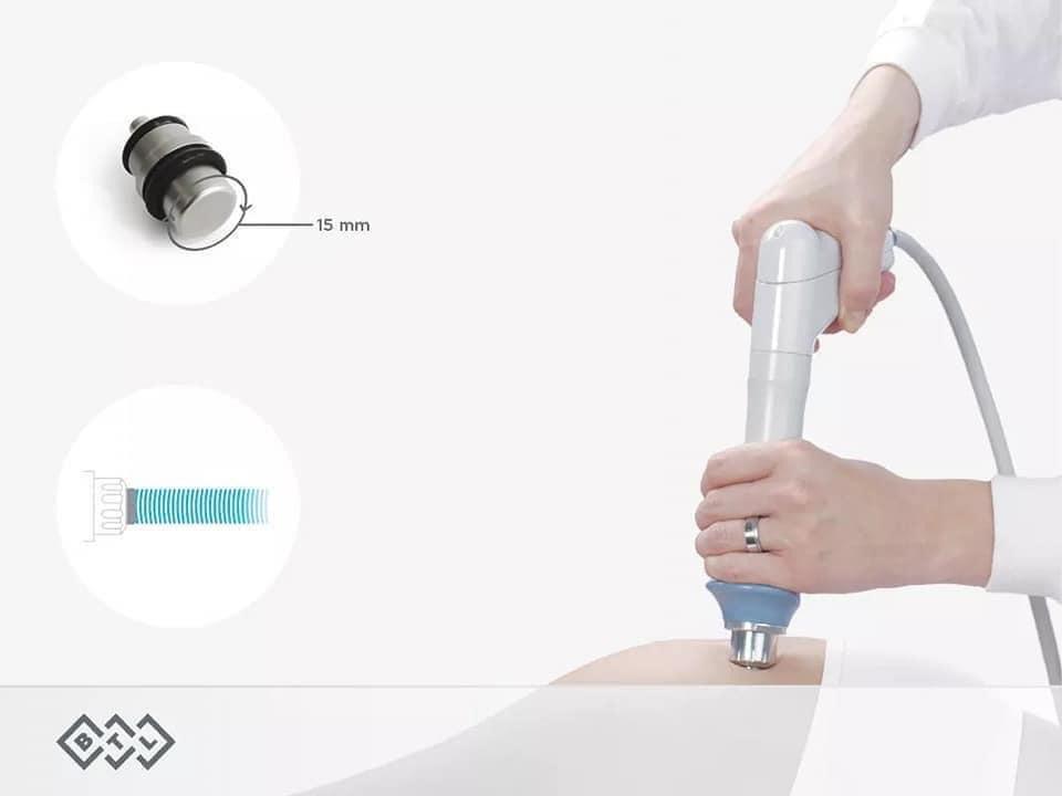 Onda d'urto radiale BTL